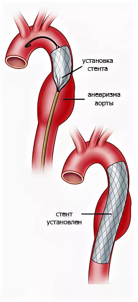 Аневризма стент. Стентирование аневризмы аорты. Стент графт грудной аорты. Аневризма брюшной аорты стент графтом.