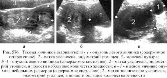 Текома опухоль гистология. Текома яичника УЗИ признаки. Текома опухоли яичников. Серозная пограничная опухоль