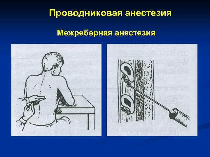 Межреберная проводниковая анестезия. Проводников анестезия. Проводниковая анестезия рисунок. Проводниковая новокаиновая блокада. Что такое проводниковая анестезия