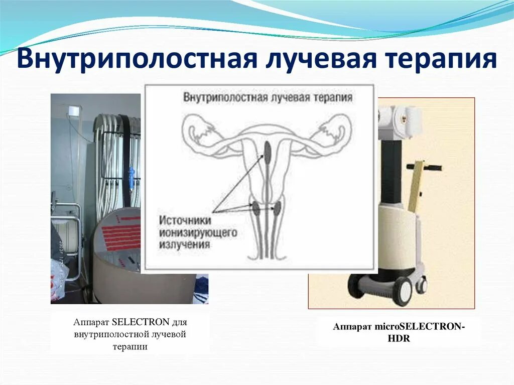 Внутренняя (контактная) лучевая терапия − брахитерапия. Внутрипросветная лучевая терапия. Эндостат лучевая терапия. Внутриполостной метод лучевой терапии. Брахитерапия рака отзывы