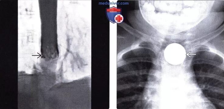 Тело пищевода. Инородное тело пищевода рентген. Инородное тело в пищеводе рентгеноскопия. Рентген пищевода (эзофагография). Рентгенодиагностика инородных тел пищевода.