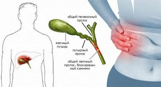 Как болит желчный пузырь где находится лечить. При загибе желчного пузыря лекарство. Желчный пузырь анатомия человека кратко. Камень в протоке желчного пузыря. Желчный пузырь анатомия человека.