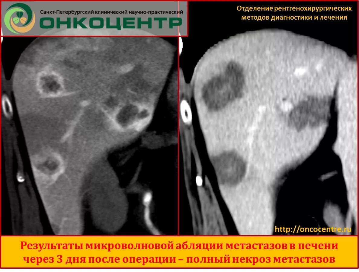 Признаки метастаз при раке. Химиоэмболизация метастазов в печени.