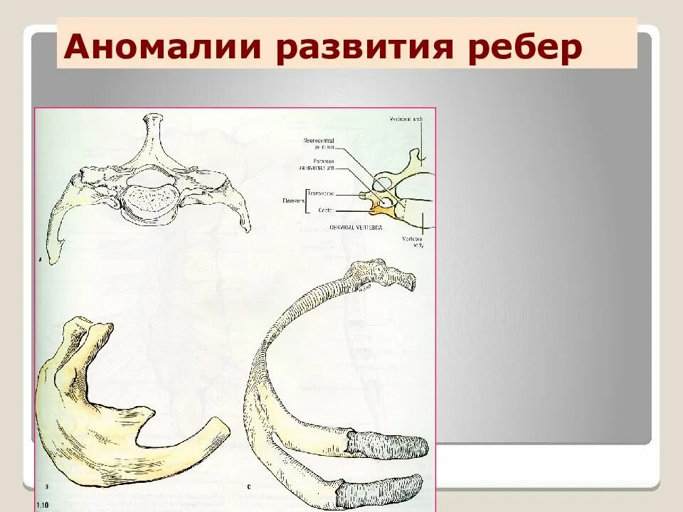 Аномалии строения. Аномалии развития ребер и грудины. аномалии развития 1 ребра. врожденная аномалия развития ребер. пороки развития грудной клетки у детей.