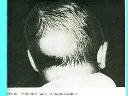 Алопеция клинические рекомендации
