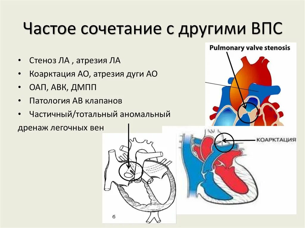 Впс сервис. Врождённый порок сердца артрио вентрикулярная коммуникация. атриовентрикулярная коммуникация полная форма. впс авк полная форма.