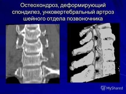 Спондилоартроз кт