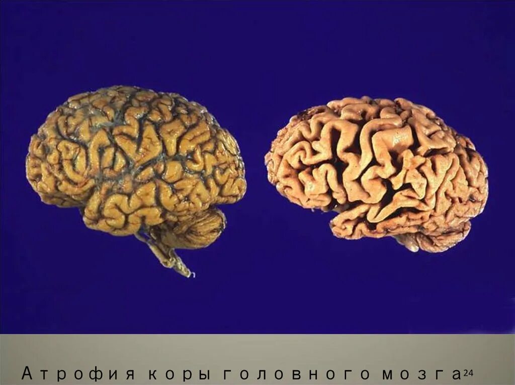 Степени атрофия мозга. Атрофические изменения коры головного мозга. Отмирание коры головного мозга. Атрофия коры головного мозга.