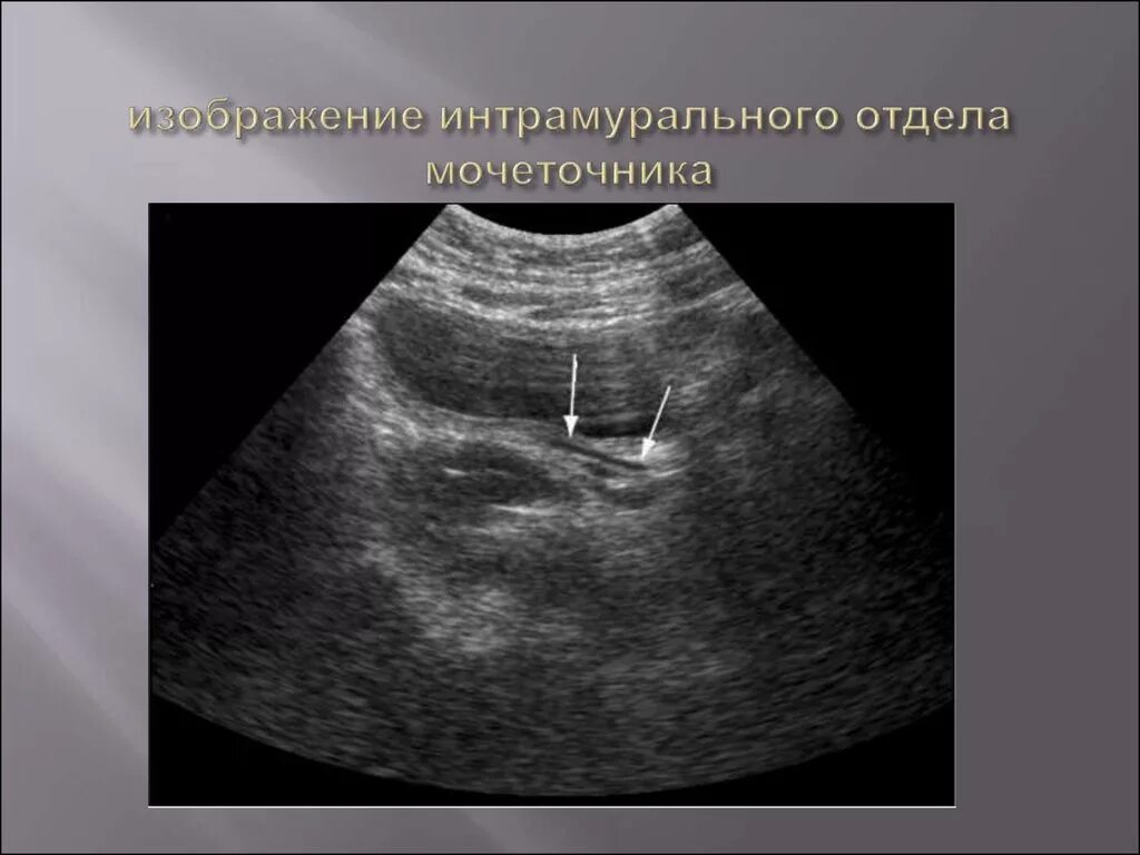 Мочеточник дистальный. Трансмуральный отдел мочеточника. Юкставезикальный отдел мочеточника камень. Интрамуральное сужение мочеточника. Юкставезикальный отдел мочеточника схема.