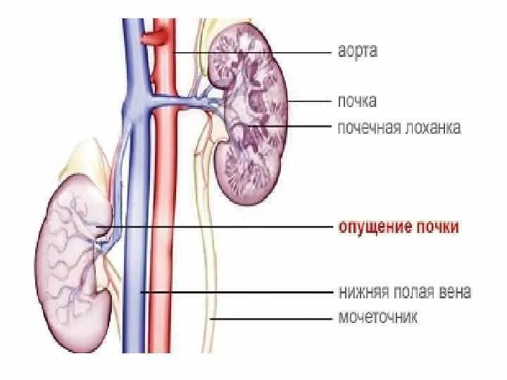 Изменение синусов обеих почек