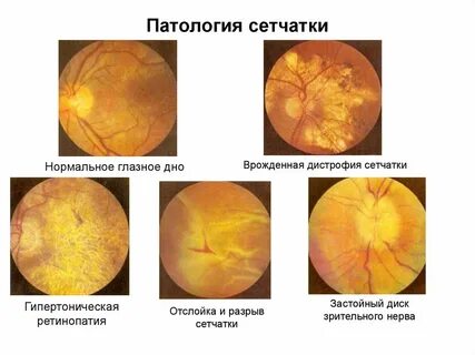 Аномалия зрительного нерва