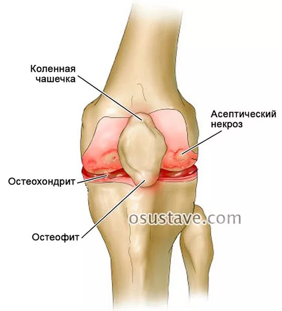 Остеохондропатия коленного сустава Кенига. Остеохондрит коленного сустава. Болезнь Кенига коленного. Некроз коленного сустава (остеонекроз).