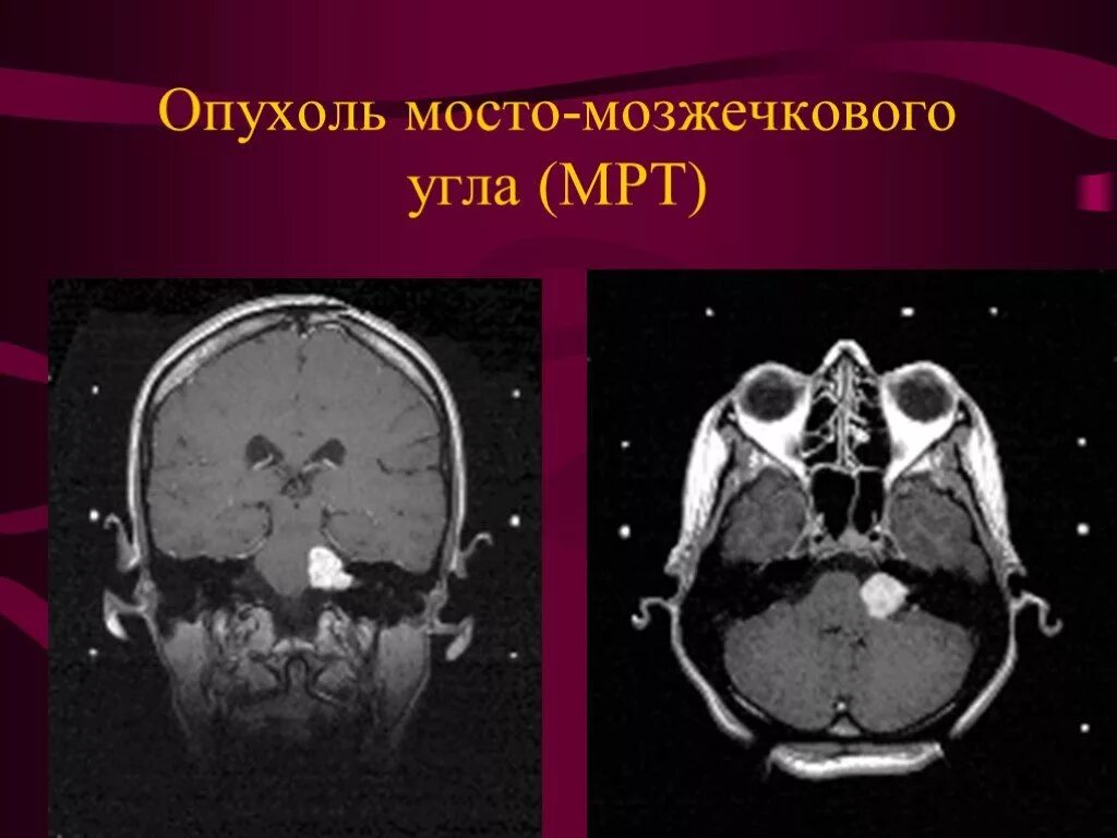 Опухоль мосто мозжечкового угла мрт. Невринома мосто-мозжечкового угла кт. Менингиома мосто-мозжечкового угла кт. Мосто-мозжечковый угол анатомия мрт. Мозжечковая опухоль