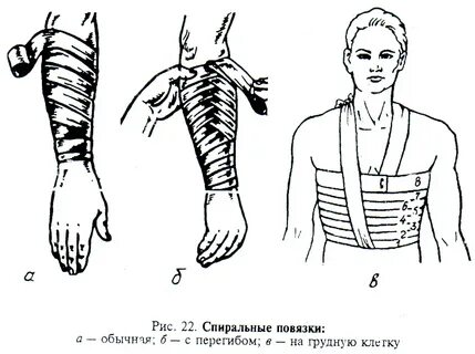 Прибинтовать конечность к туловищу