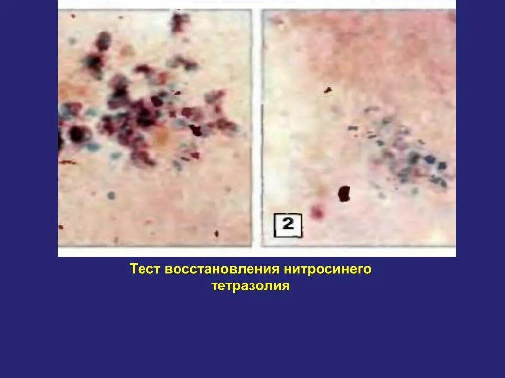 Реставрация тесты. Нитросиний тетразолий. НСТ тест. Тест с нитросиним тетразолием. НСТ тест нейтрофилов.