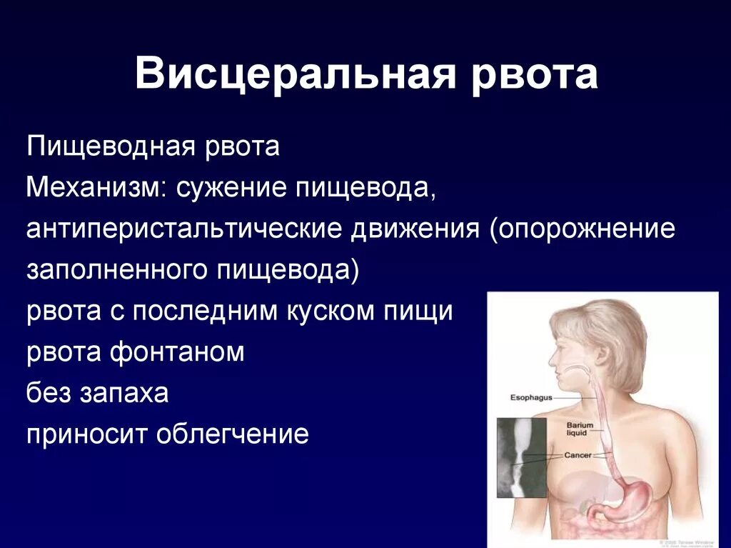 Висцеральная рвота. Висцеральная рвота механизм. Пищеводная рвота. Механизм пищеводной рвоты. Пищевода тошнота