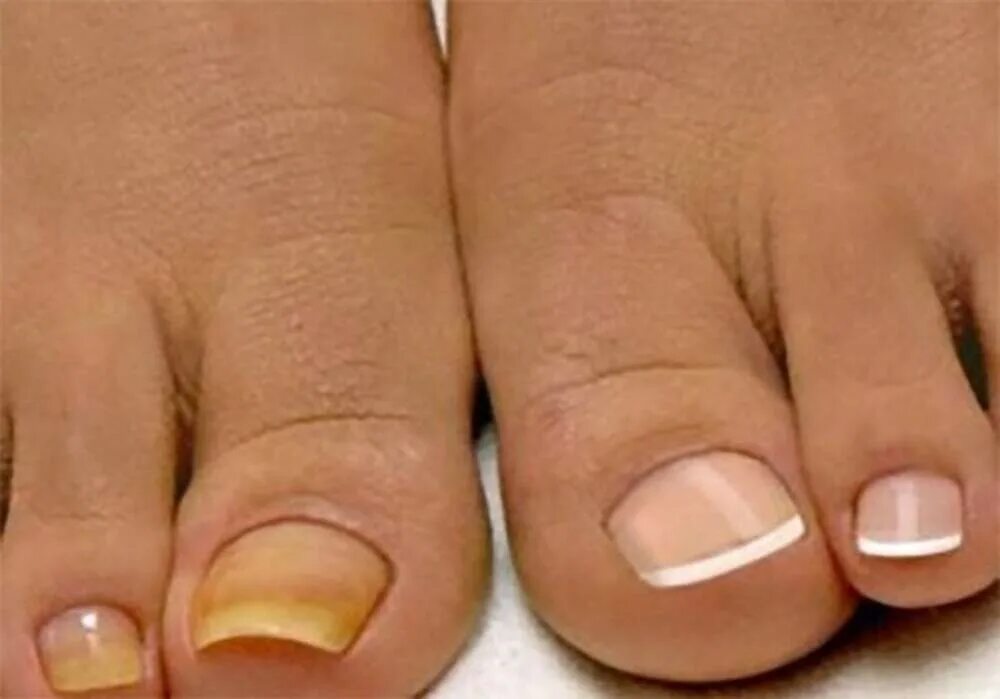 Педикюр грибковых ногтей. (Онихомикоз) онихомикоз ногтей. Онихомикоз онихокриптоз. Онихомикоз ( обработка грибковых ногтей).