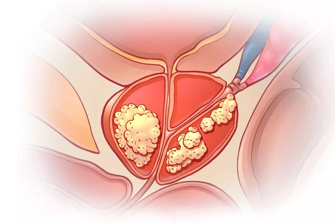 Опухоль предстательной железы. Онкология предстательной железы. Рак предстательной цена