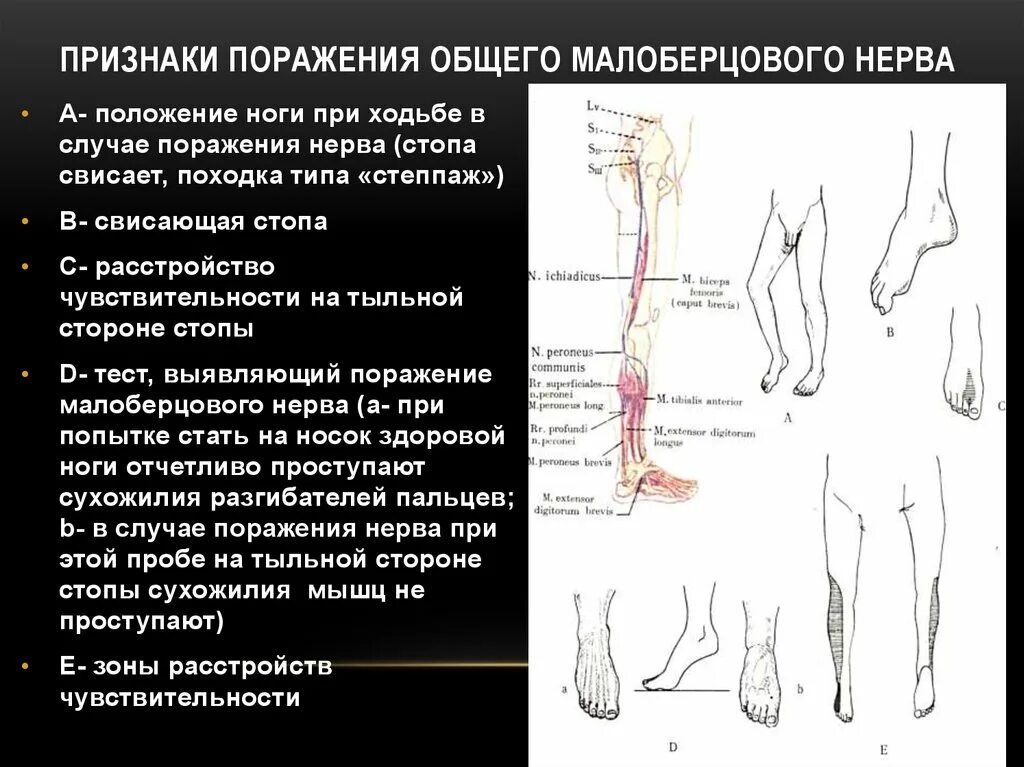 Сенсорное поражение нижних конечностей. Характерный симптом невропатии малоберцового нерва. Аксональная нейропатия малоберцового нерва. Методика выявления симптомов поражения малоберцового нерва. Поражение большеберцового нерва симптомы.