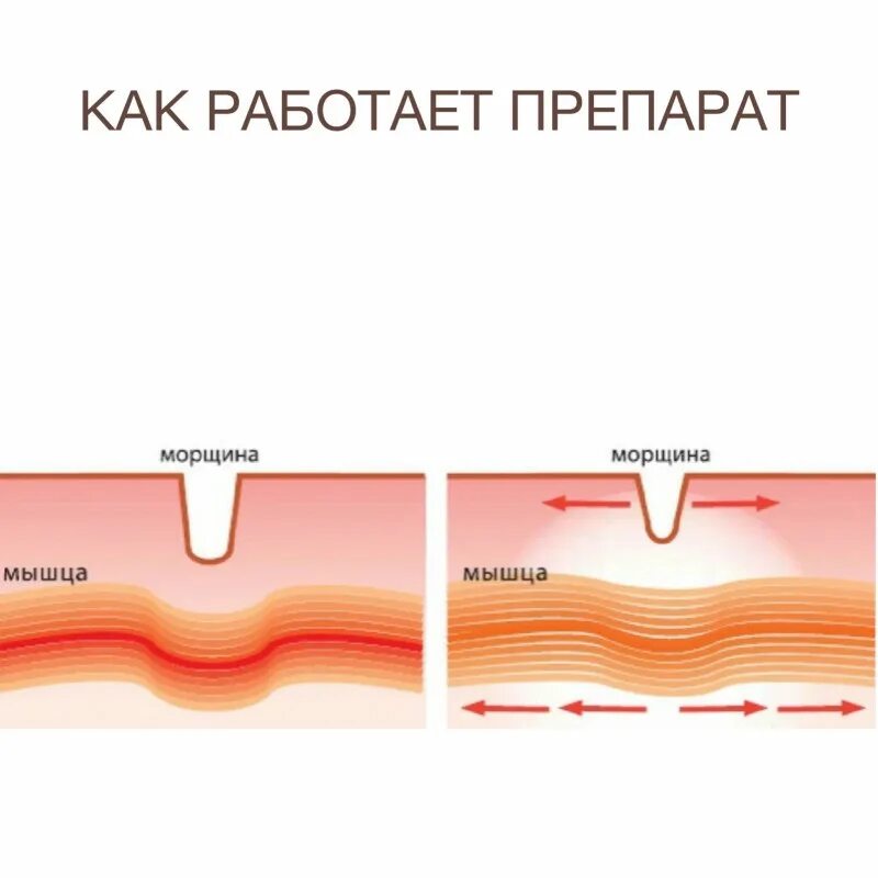 Почему образовываются складки. Механизм образования морщин. Морщины схема. Механизм образования морщин на коже. Механизм действия ботокса на мышцы.