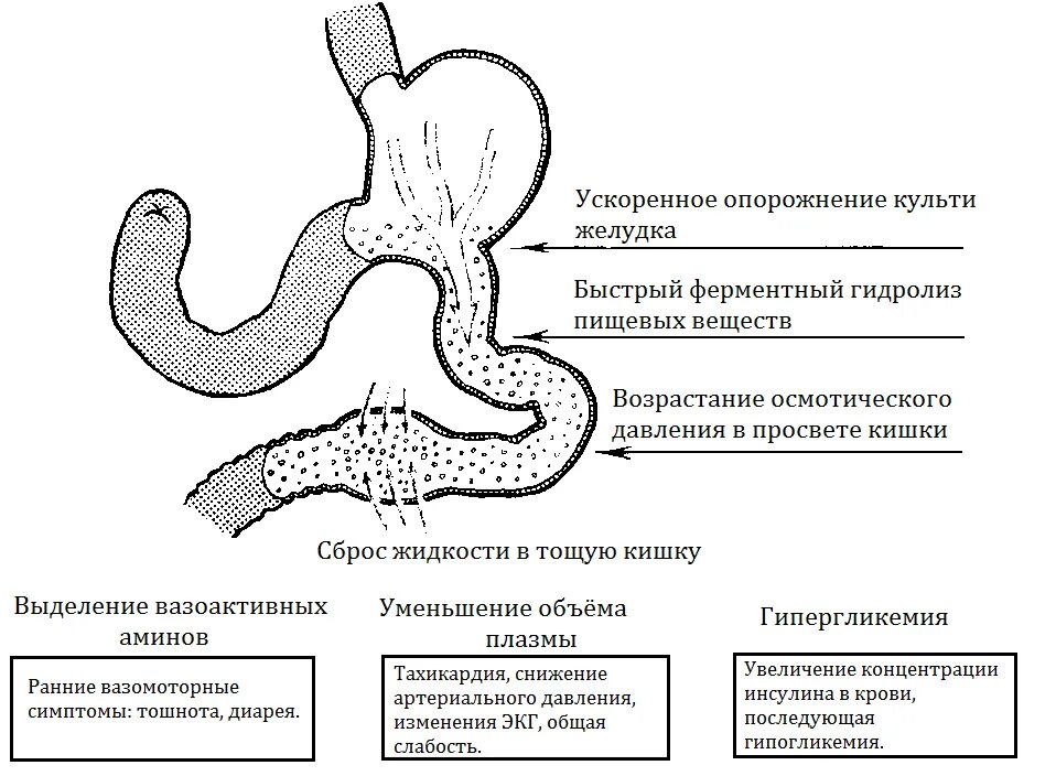 Демпинг синдром этиопатогенез. Ранний демпинг синдром механизм. Демпинг синдром после резекции желудка. Демпинг синдром этиология.