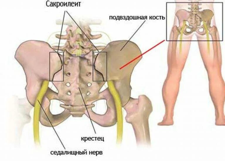 Сильная боль в подвздошной. Крестцово подвздошное сочленение болезнь сакроилеит. Воспаление крестцово-подвздошного сустава. Мрт КПС (крестцово-подвздошных сочленений). КПС сустав крестцово-подвздошный.