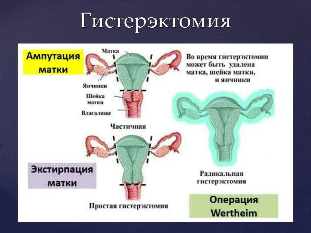 Лимфоузлы и удаление матки. Экстирпация матки ампутация матки отличия. Энергосберегающая расширенная экстирпация матки с придатками. Влагалищная тотальная гистерэктомия. Ампутация матки матки отличия.