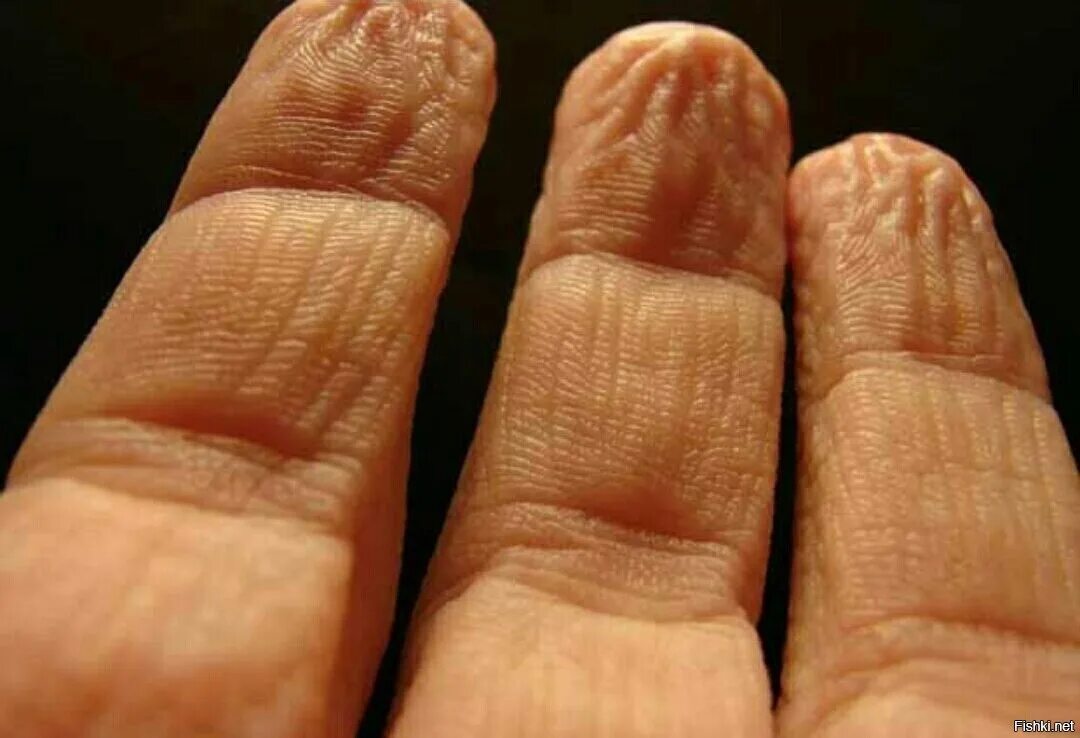 Почему мокрые пальцы. Почему мокрые пальцы. Почему мокрые пальцы. Пальмарный ладонный гипергидроз. Почему мокрые пальцы.
