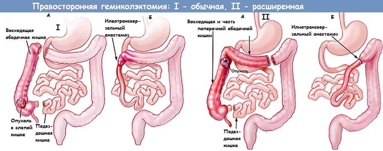 Операция резекции Толстого кишечника. Толстая кишка резекция кишечника. Резекция Толстого кишечника ход операции. Субтотальная гемиколэктомия. Что делать после операции на кишечнике