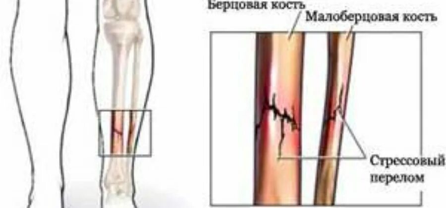 После операции на берцовой кости. Реабилитация перелома малой малой берцовой. Малоберцовая кость перелом. Перелом малой берцовой кости. Перелом большеберцовой и малой берцовой кости.