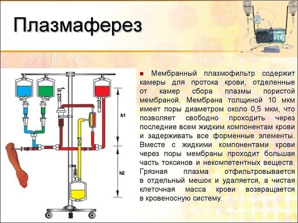 Плазмоферез что это