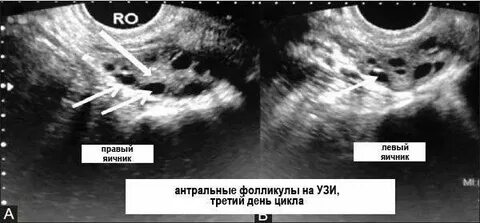 Антральные фолликулы что это