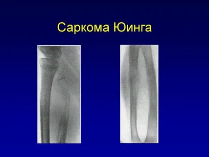 Саркома юинга что