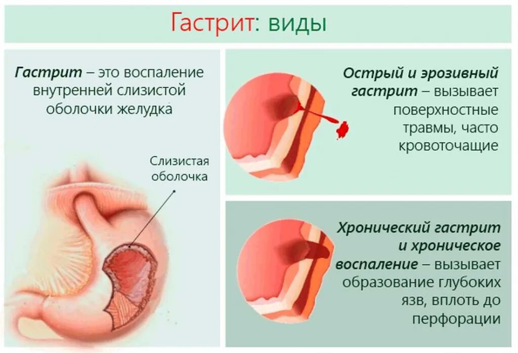 Острый и хронический гастрит отличия. Острый гастрит и хронический гастрит. Симптоматика острого и хронического гастрита. Причина гастрита б