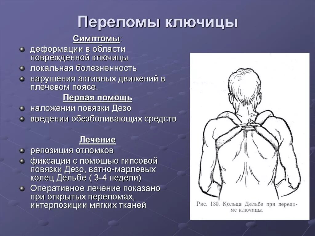 Трещина симптомы лечение. Вправление перелома ключицы. Перелом ключицы методы лечения. Перелом ключицы симптомы. Признаки перелома ключицы.