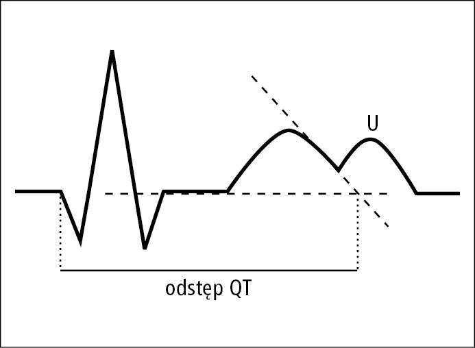 Удлиненное qt на экг. Удлиненный интервал qt на ЭКГ что это такое. Синдром укороченного интервала qt. Удлинение интервала qt на ЭКГ И Пируэт. U=qt.