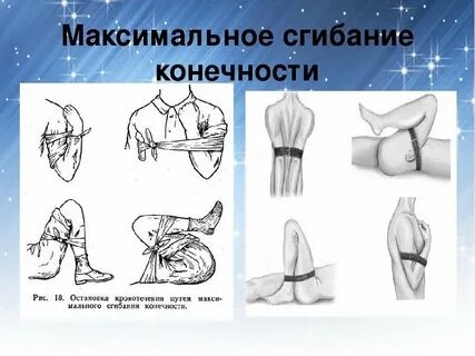 Способ остановки кровотечения максимальное сгибание конечности
