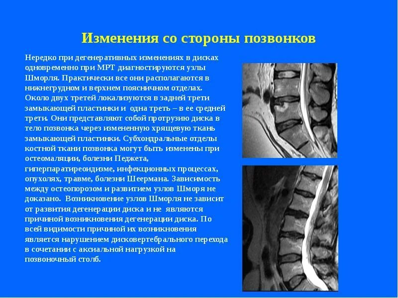 Мр дистрофических изменений пояснично крестцового отдела позвоночника. Дегенеративные изменения позвонков мрт. Узлы Шморля в позвоночнике что это. Дегенеративные изменения поясничного отдела позвоночника. Дегенеративное извинения позвоночника.