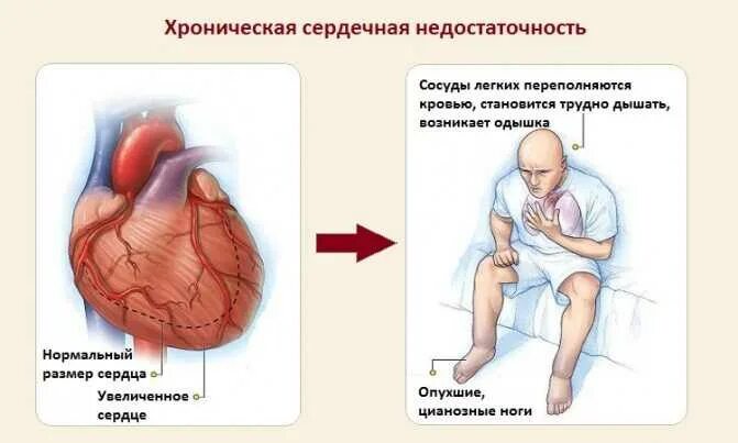 Сердечная недостаточность что хорошо. Одышка это признак сердечной недостаточности. Хроническая сердечная недостаточность жалобы пациента. Сердечная недостаточность ортопноэ. Хроническая легочно-сердечная недостаточность.