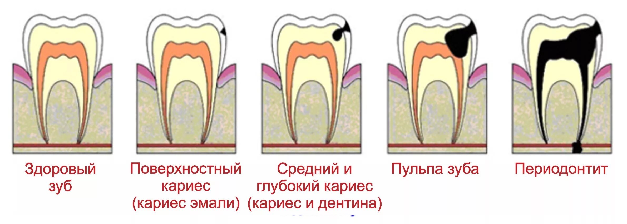 Кариес пульпит периодонтит. Осложнение лечения периодонтита