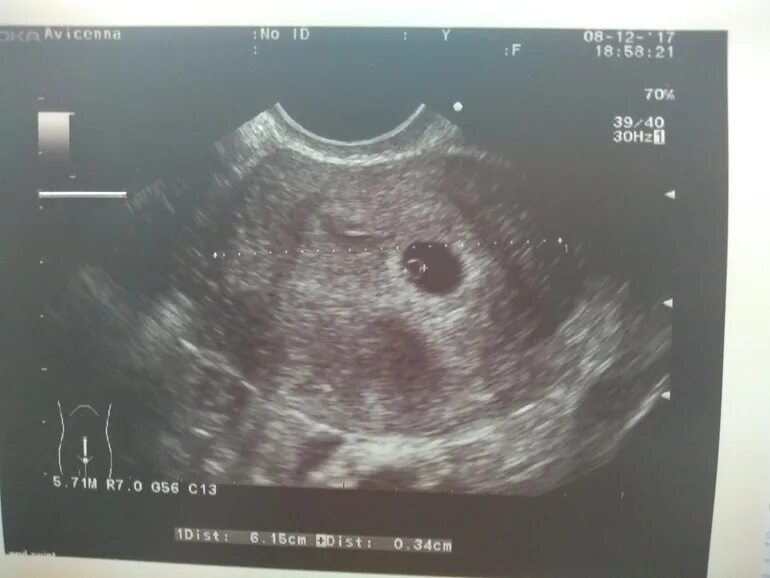 Маточная беременность на ранних сроках. Маточная беременность. Ампулярная беременность. Внематочная беременность. Маточная беременность фото.