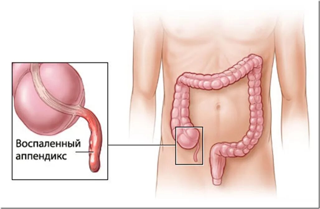 Аппендицит с какой стороны находится фото