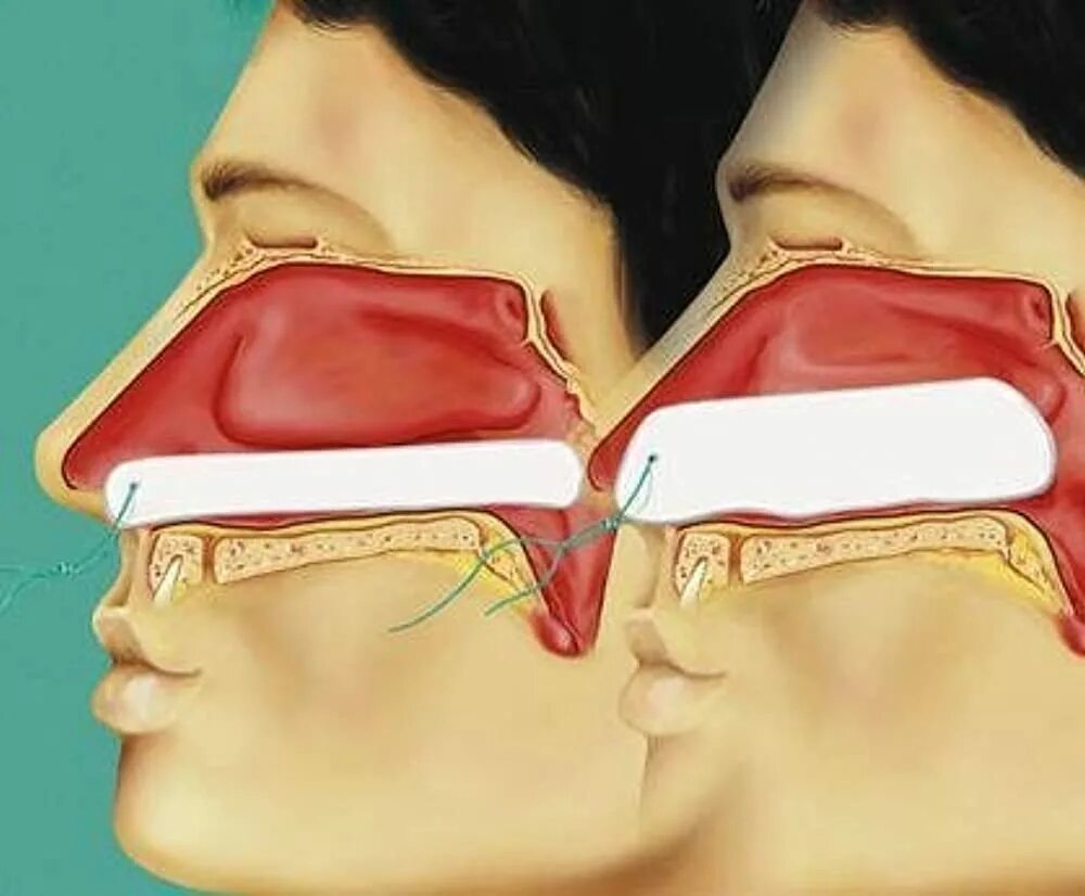 Силиконовые пластины в носу. Пластины для септопластики. Тампоны в нос после операции