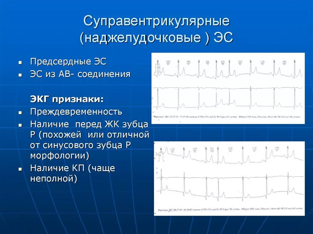 Желудочковая экстрасистолия диагноз экг. Суправентрикулярная экстрасистолия экг критерии. Наджелудочковая экстрасистолия на экг что это. Единичная наджелудочковая экстрасистолия. Наджелудочковая экстрасистолия на экг.