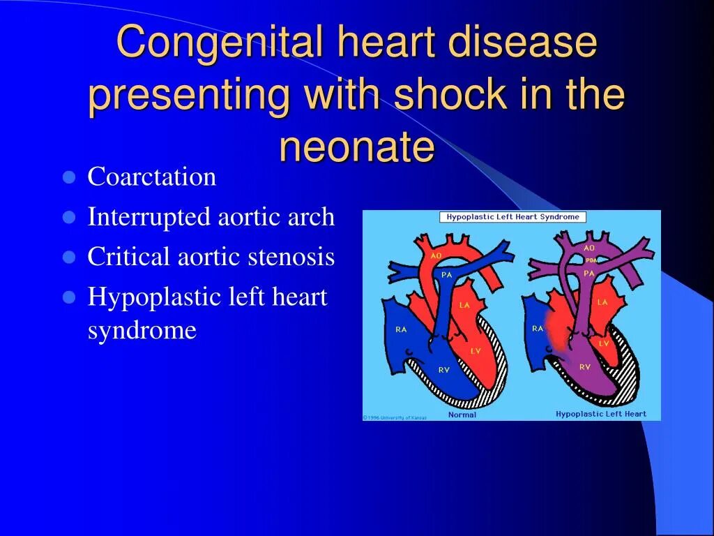 Congenital heart disease classification. Congenital heart disease. Pulmonary blood flow. Heart defects classification. Congenital heart disease.