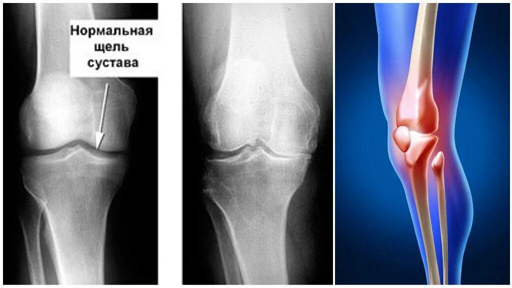 Остеоартроз коленного сустава рентгенограмма. Диспластический гонартроз. Деформирующий артроз коленного сустава рентген. Артроз коленного сустава название