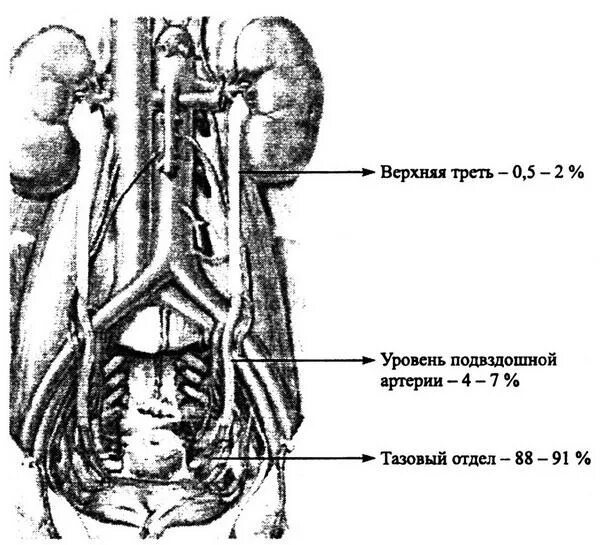 Мочеточник слева. Камень в нижней трети мочеточника. Сужения мочеточника анатомия. Травмы мочеточника урология. Топография мочеточника.