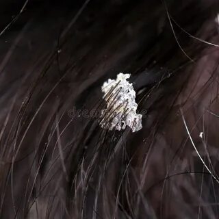 Перхоть сканворд