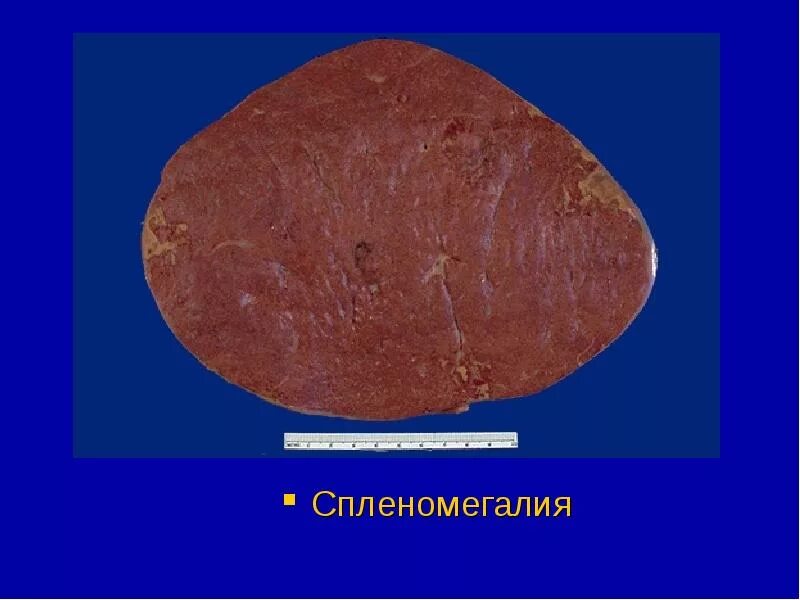 Амилоидоз селезенки микропрепарат гематоксилин эозин. Неопухолевые заболевания. Иммунопатологические процессы патанатомия. Хронический миелолейкоз селезенка. Образования селезенки.