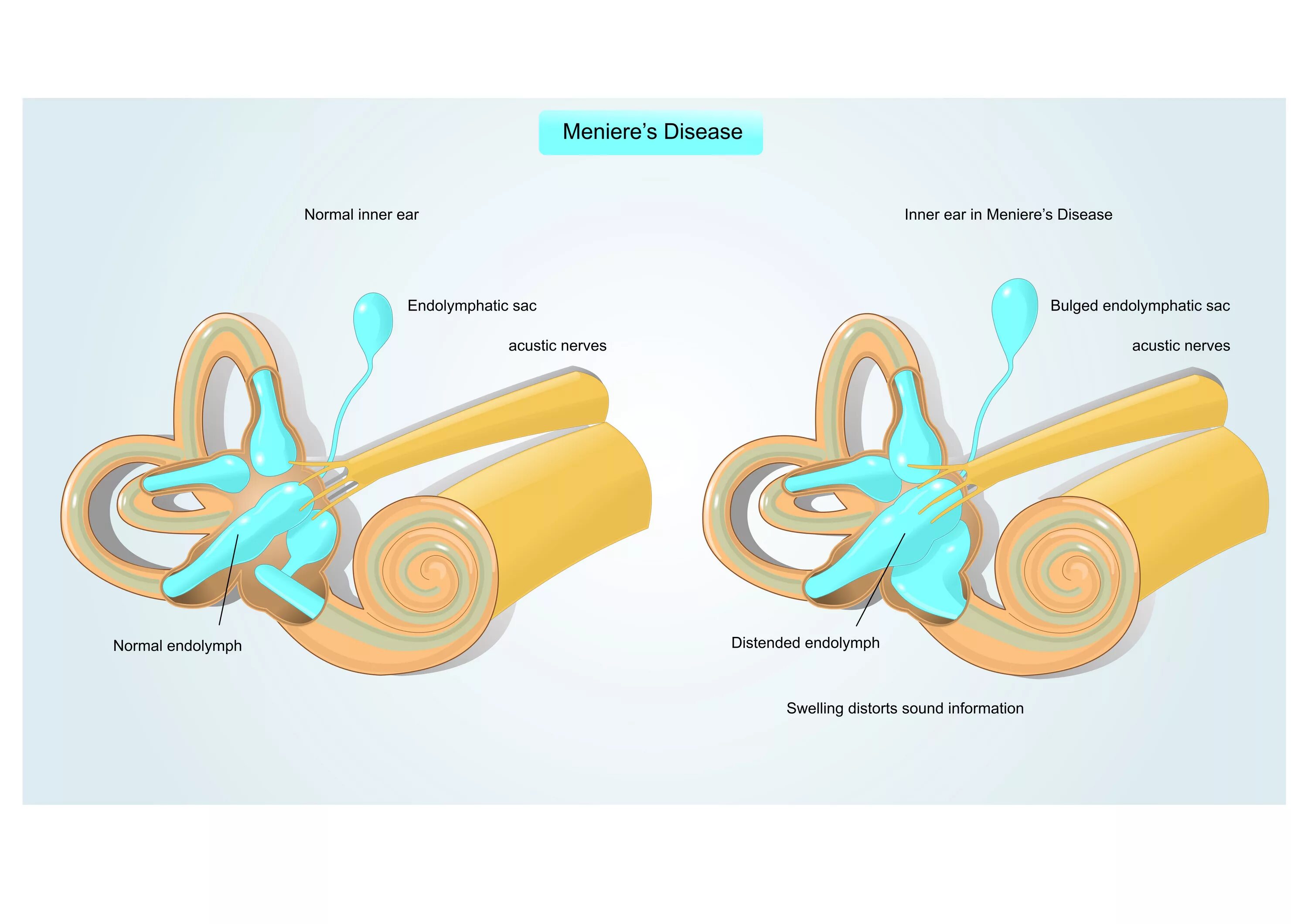 Болезни внутреннего уха Меньера. Вестибулярная форма болезнь Меньера. Слуховая и вестибулярная системы, синдромология. Синдром Меньера.. Болезнь Меньера патогенез. Болезнь внутреннего уха